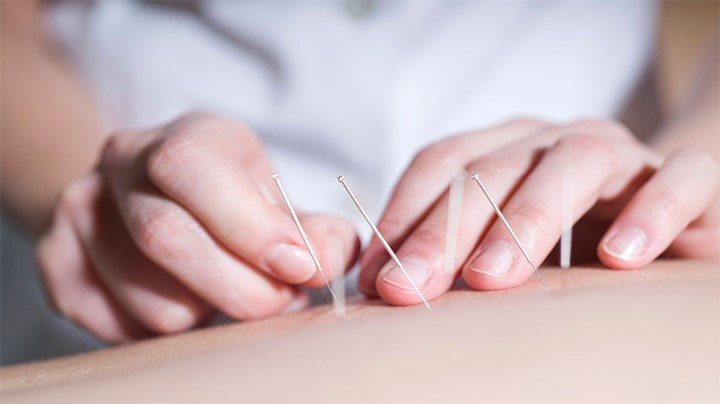 Prácticas de acupuntura